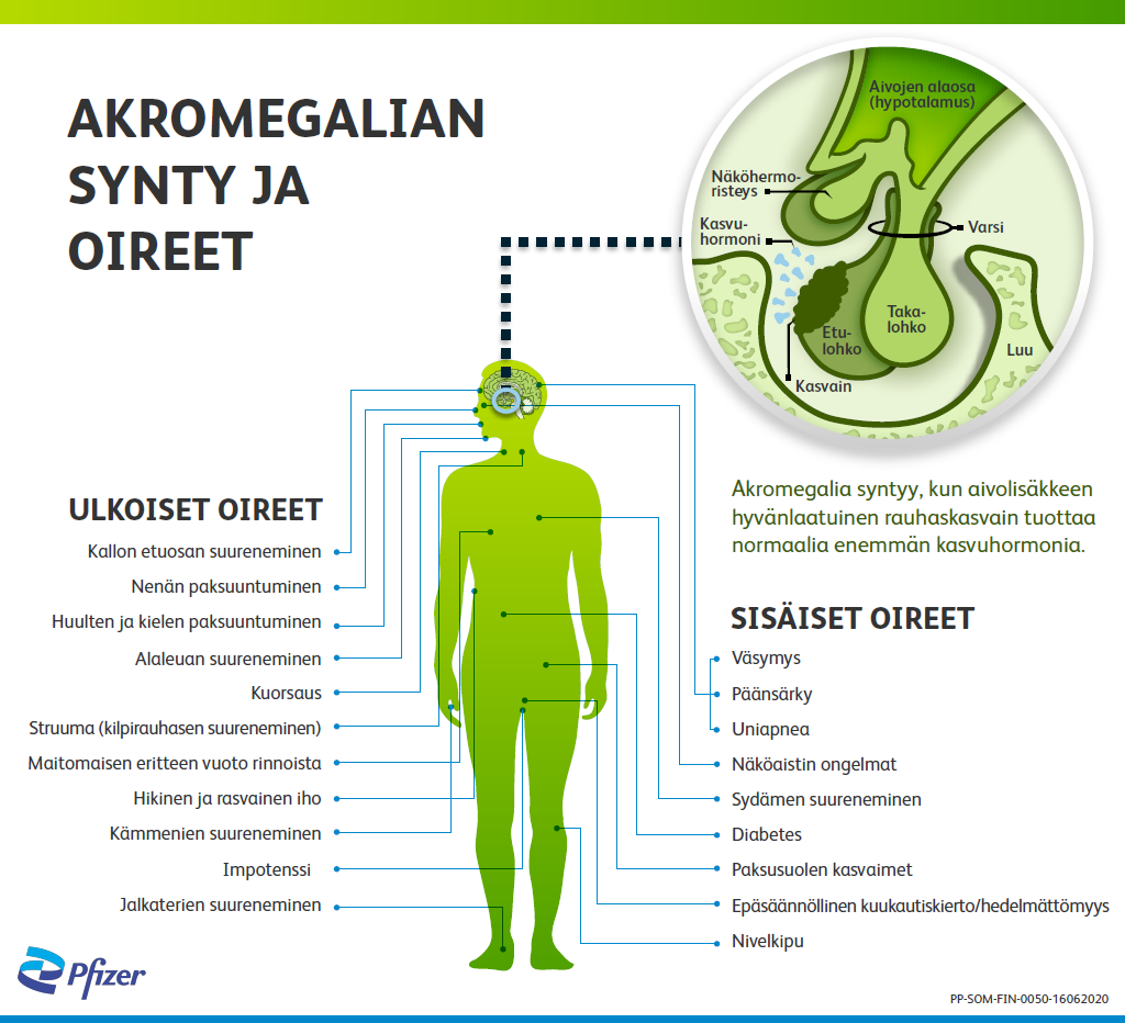 Akromegalian synty ja oireet